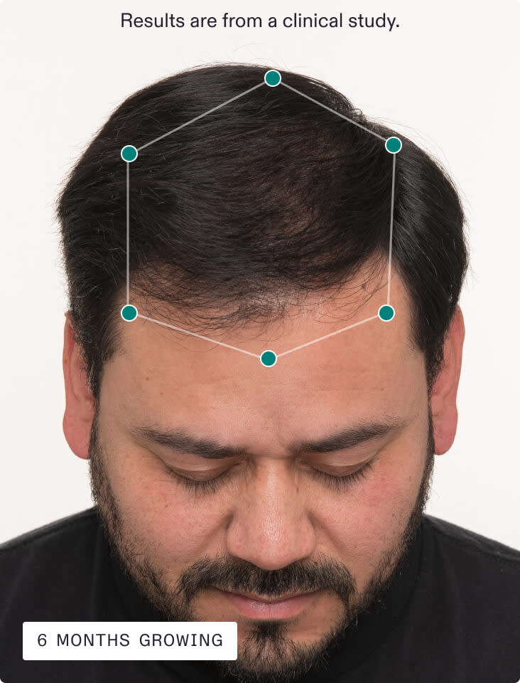 Nutrafol Men after photo — Month 6 from official clinical study (brand image)