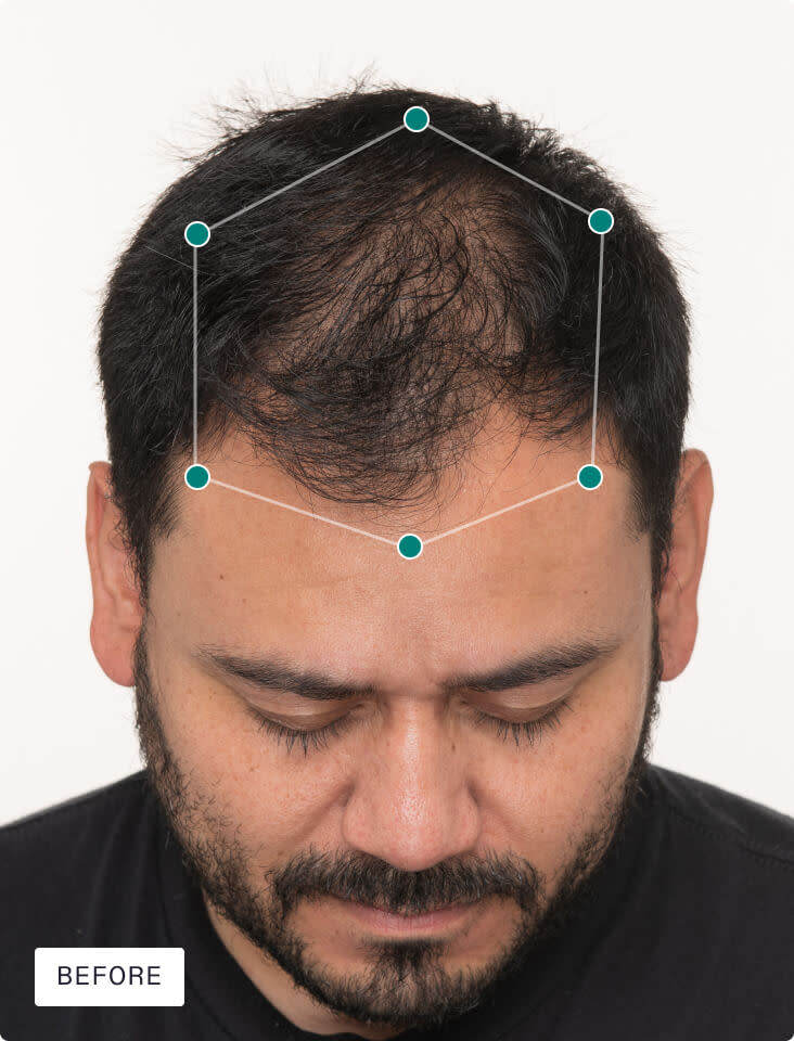 Nutrafol Men before photo — Month 0 from official clinical study (brand image)